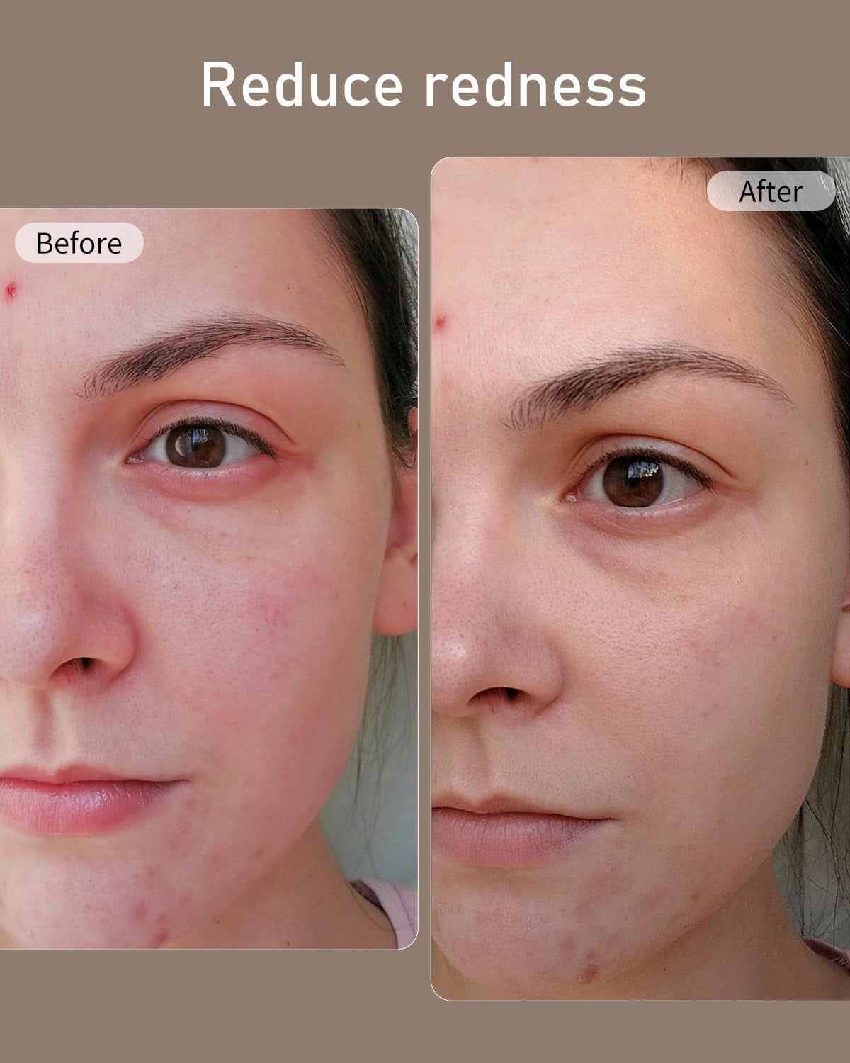 LED Face Mask, Red Light Therapy Mask, Five Modes Blue Light Therpay, Face Zone Maping, Remote Control, 4000Mah, Storage Bag, Head Strap, Eye Pads(S/M/L), Gift for Wife, Girls(White)